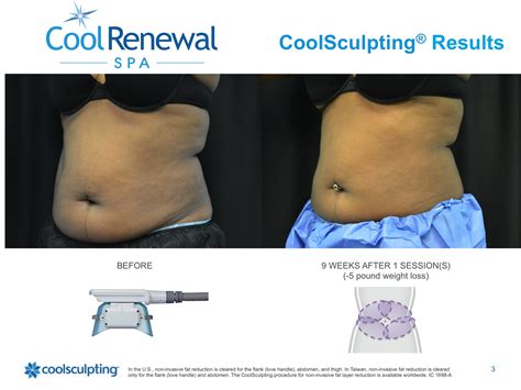 coolsculpting philippines|CoolSculpting Manila Cost, Prices, Before and After Photos.